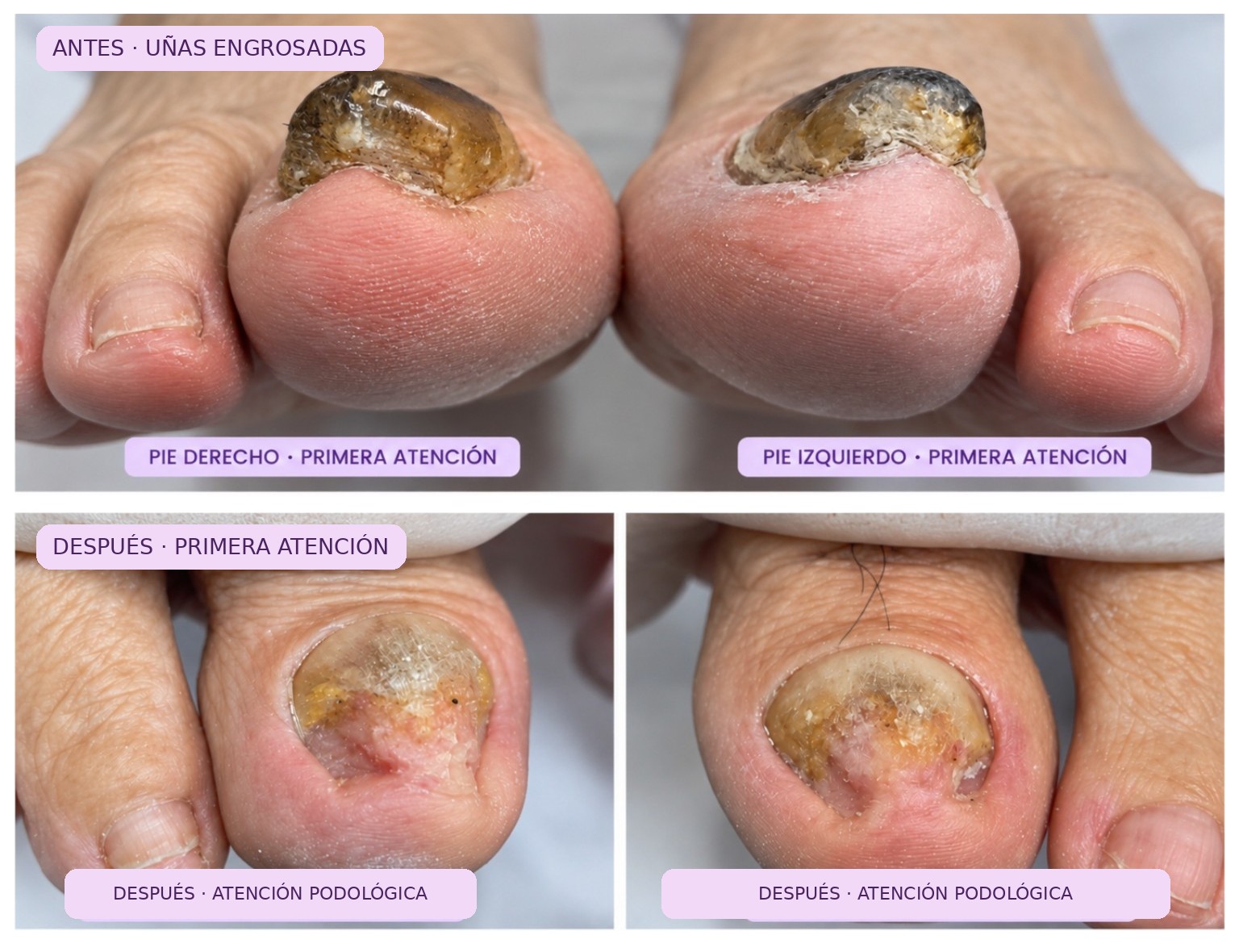 Caso real de onicomicosis profunda: antes arriba, con las uñas engrosadas; dos fotografías después de la primera atención debajo, una al lado de la otra